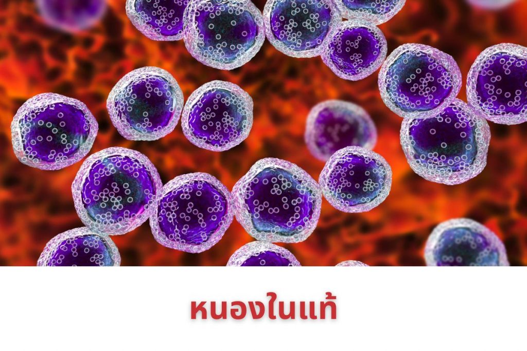 หนองในแท้