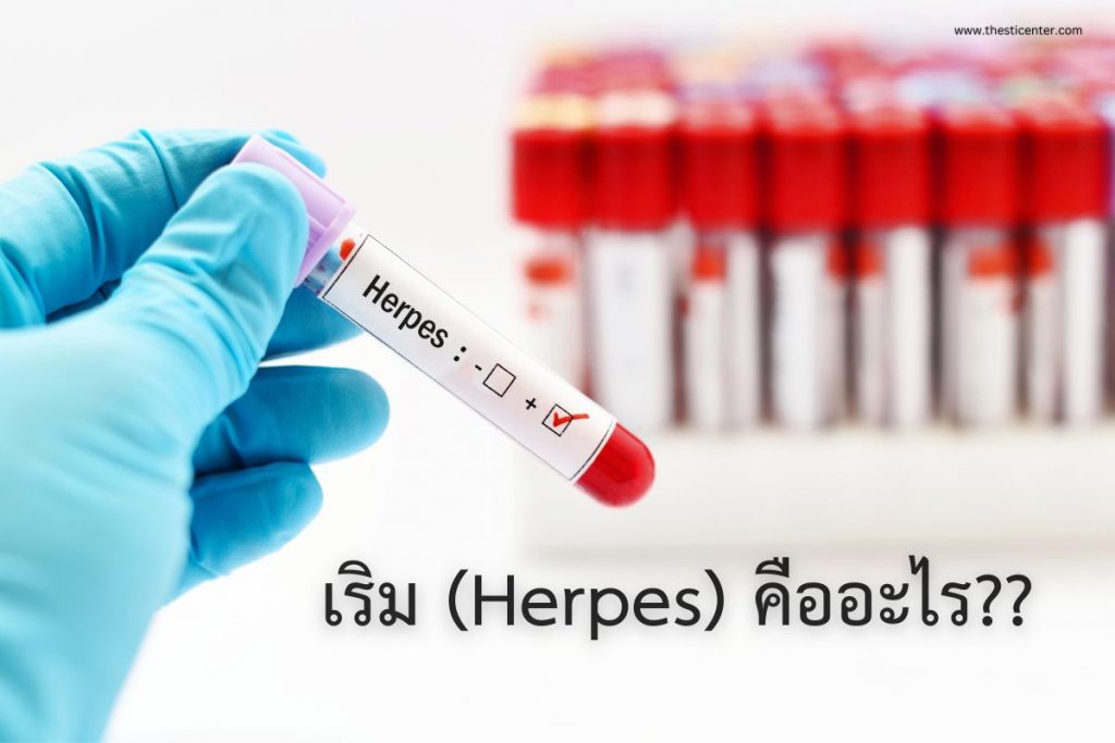 เริม (Herpes) คืออะไร??