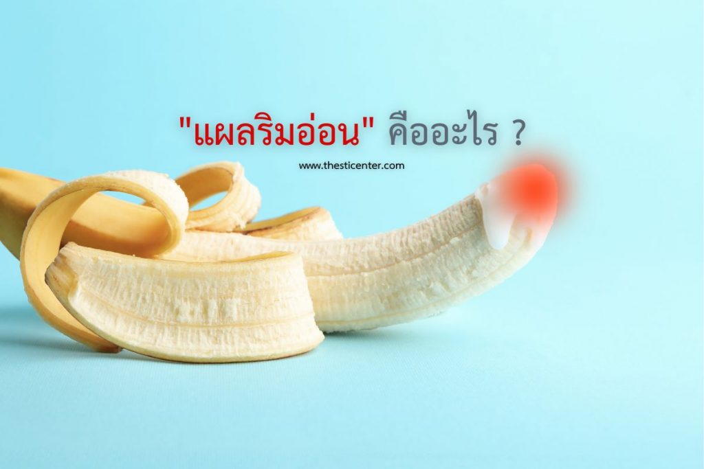แผลริมอ่อน คืออะไร ?