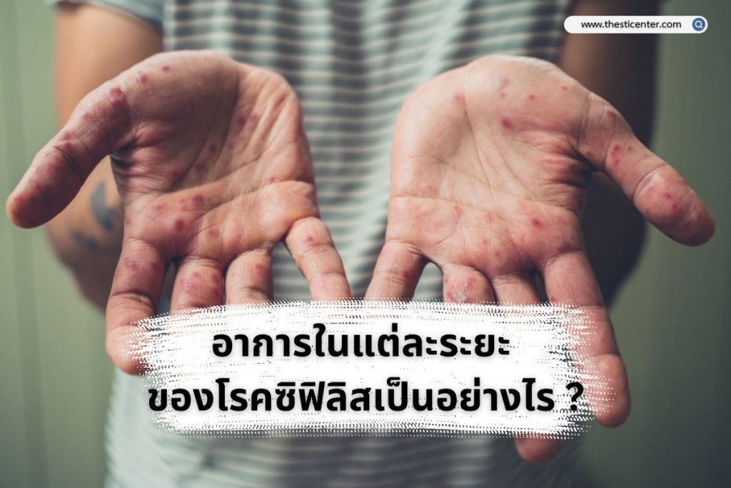 อาการในแต่ละระยะ ของโรคซิฟิลิสเป็นอย่างไร