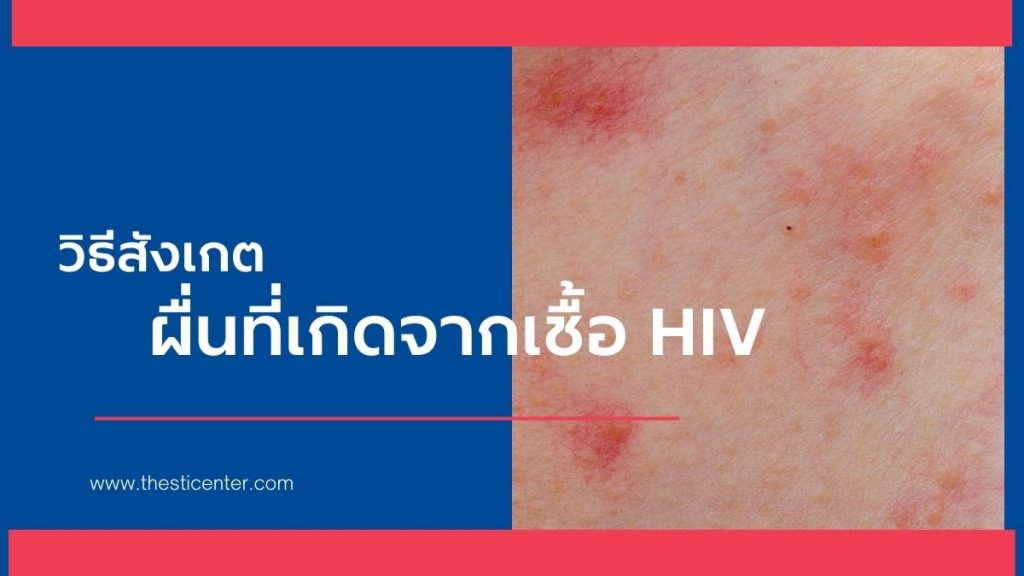 วิธีการสังเกตผื่นที่เกิดจากเชื้อ HIV