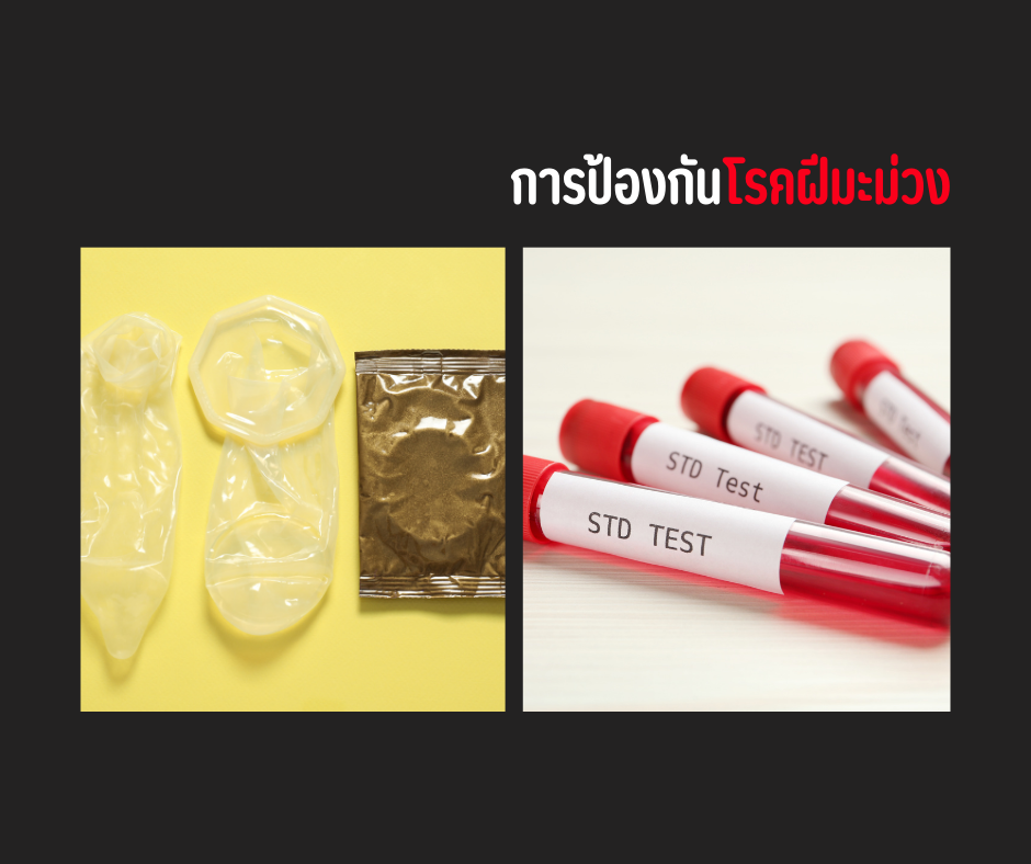 การป้องกันโรคฝีมะม่วง