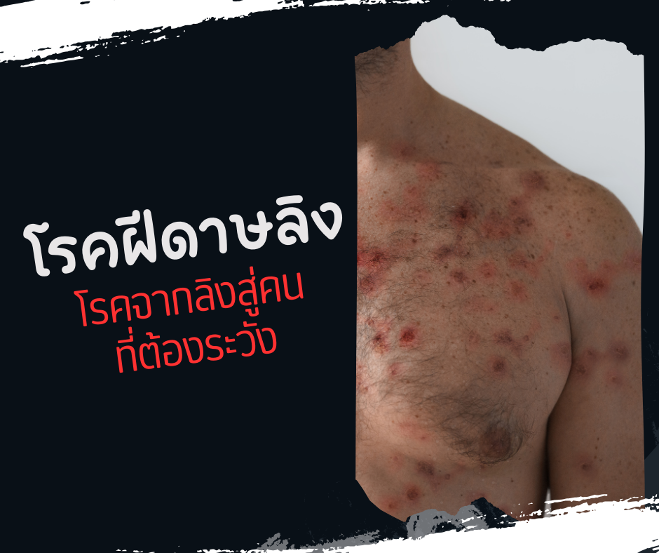 โรคฝีดาษลิง โรคจากลิงสู่คน ที่ต้องระวัง