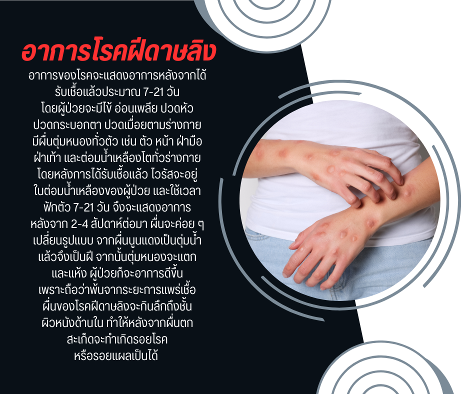 อาการโรคฝีดาษลิง